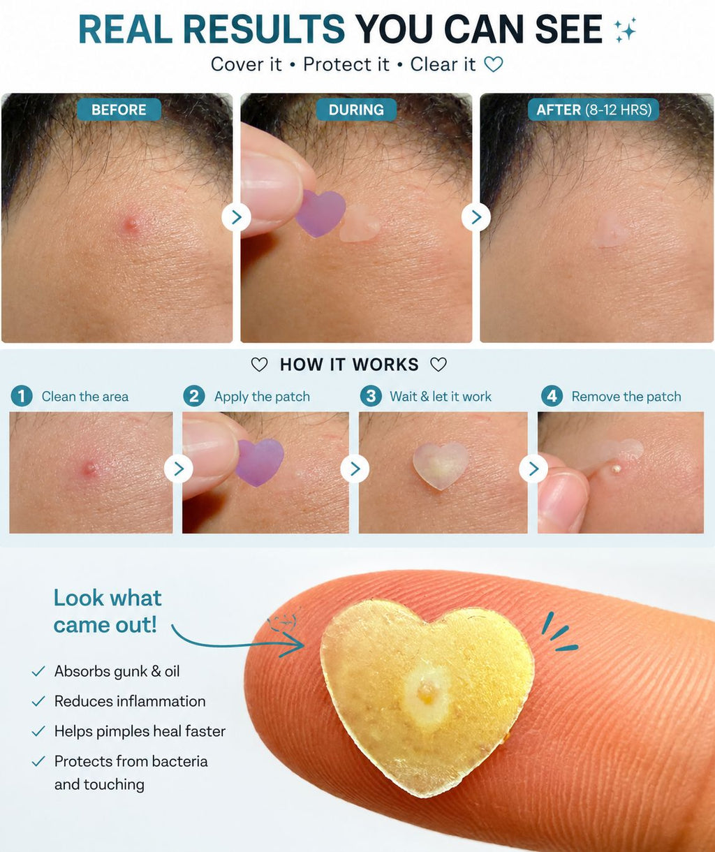 Masa Peak Acne Patches – 72 Hydrocolloid Star & Heart Patches with Salicylic Acid